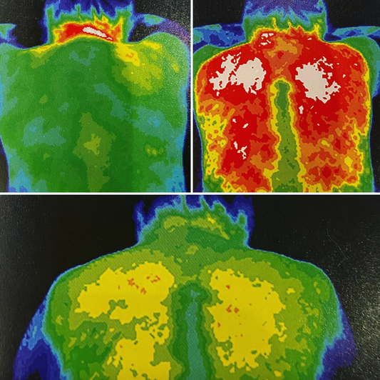 The Efficacy of Cupping Through Thermographics